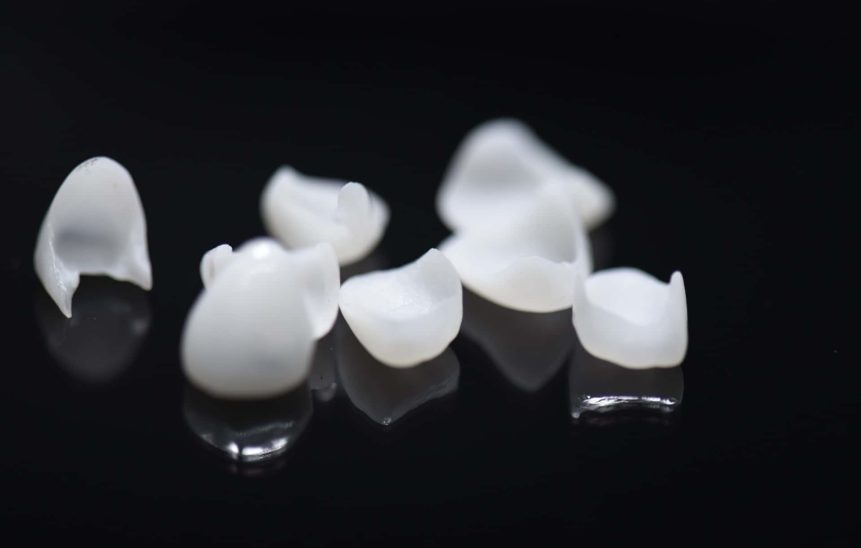 Veneers Composite Veneers