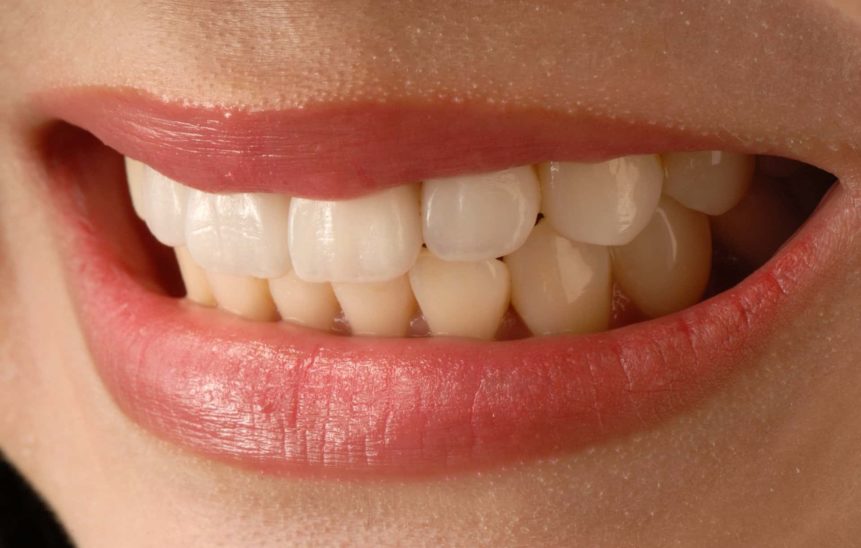 Veneers Cosmetic Dentistry