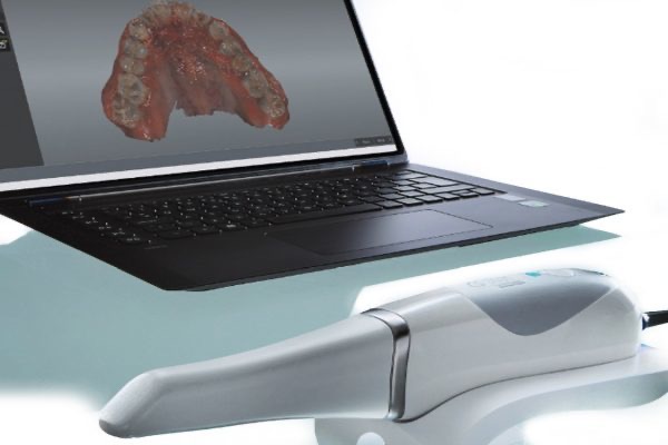 Intra Oral Scanner enable precise 3D scans of your mouth